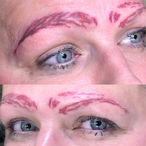 Bad Microblading MIcrobladed Eyebrows Saline Tattoo Removal Non Laser Tattoo Removal