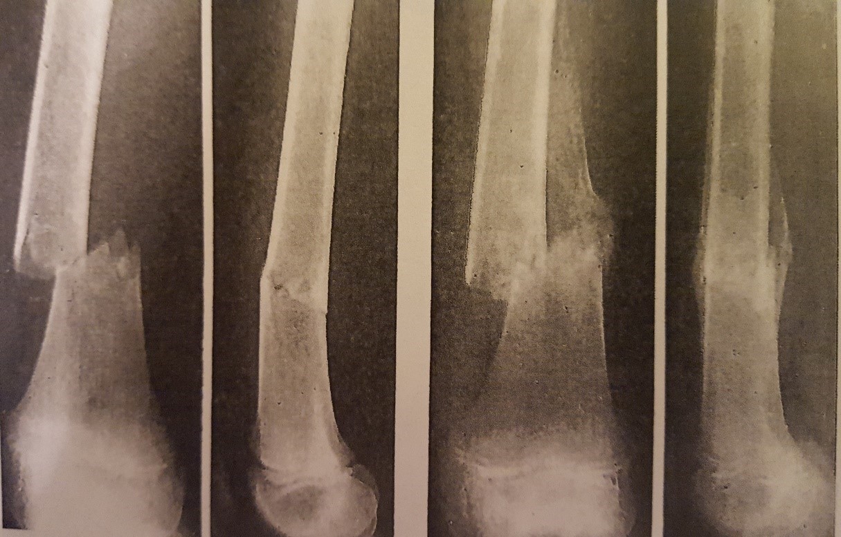 pathology-of-fractures-and-fracture-healing