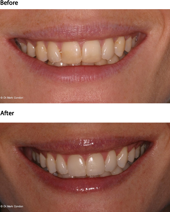 two veneers on front teeth