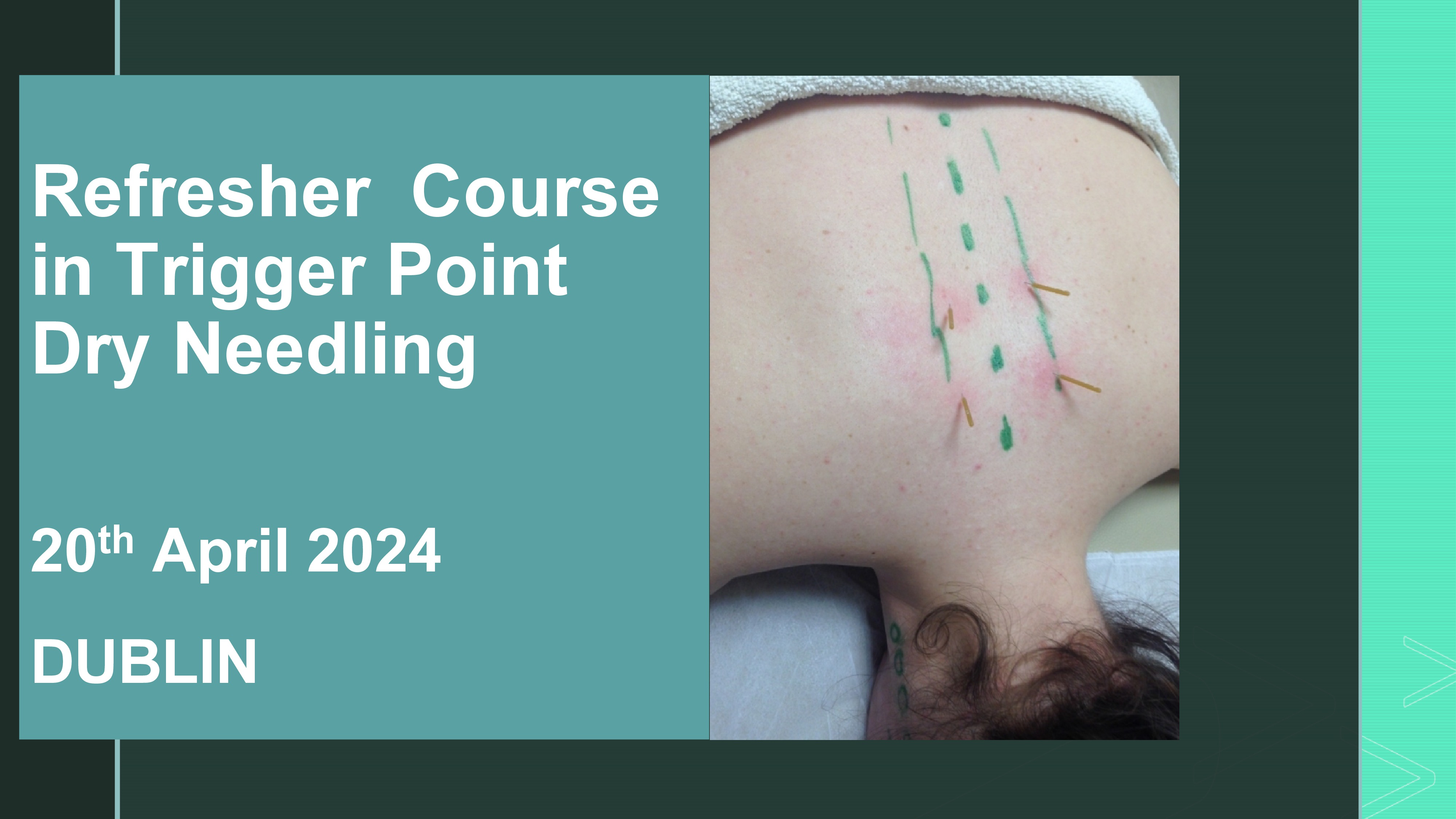 Refresher Course in Trigger Point Dry Needling 20th April 2024 DUBLIN
