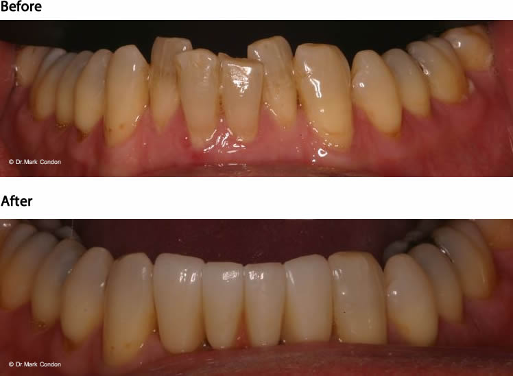 Dental Bridge Case 1 - Camden Dental Clinic Dublin
