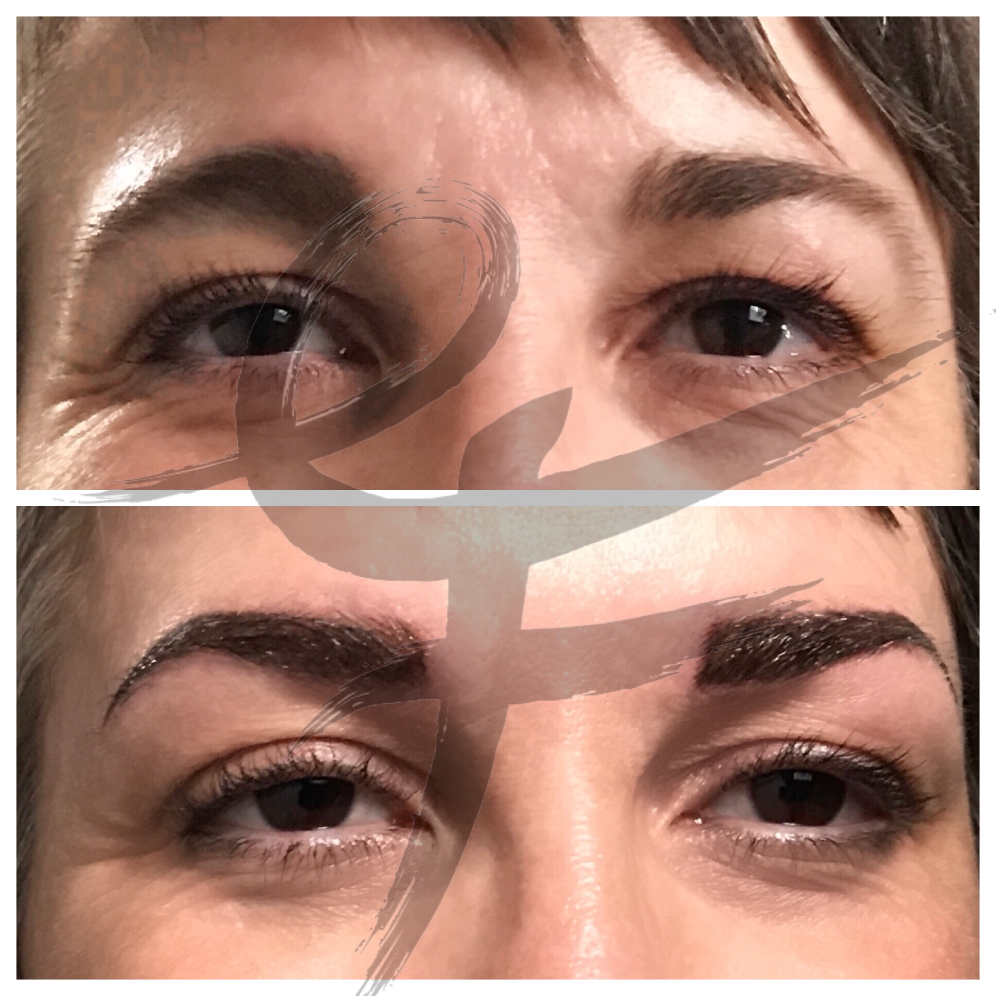 Corrected asymmetrical brows with drooping tails to give a more balanced and youthful appearance.