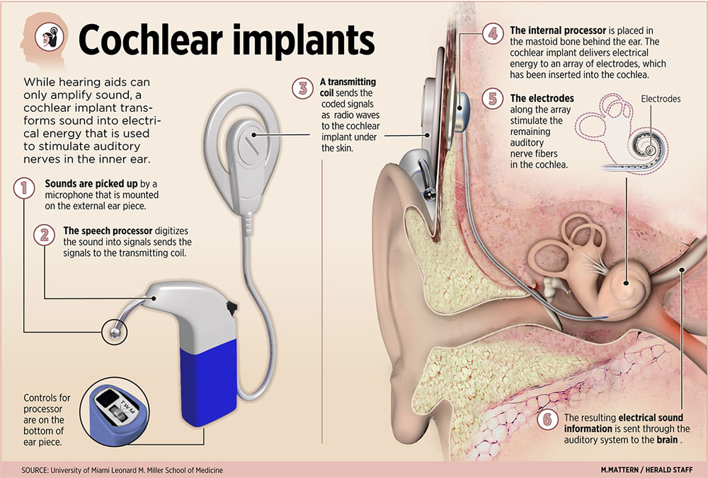 cochlear-implant.jpg