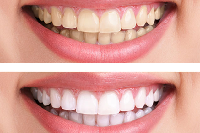 how safe is teeth bleaching