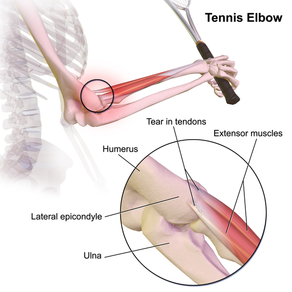 600px-tennis_elbow.png