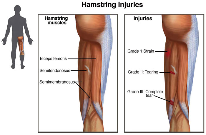 How Can You Tell If You Tore Your Hamstring