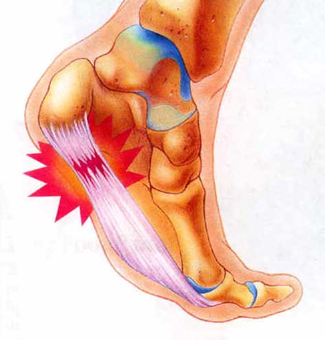 plantarfasciitis2.jpg