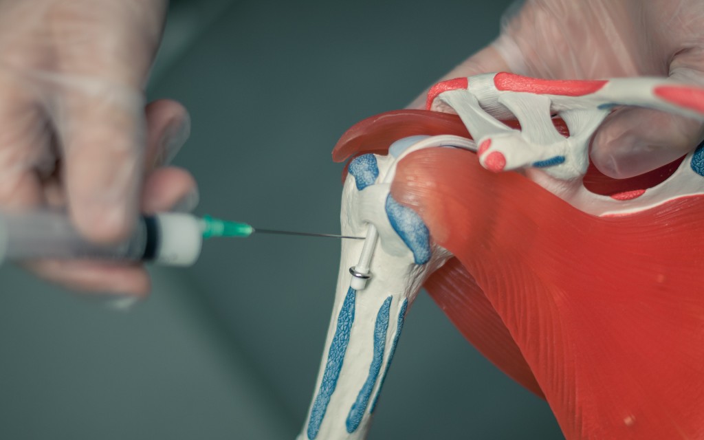 Shoulder Rehab Sweden