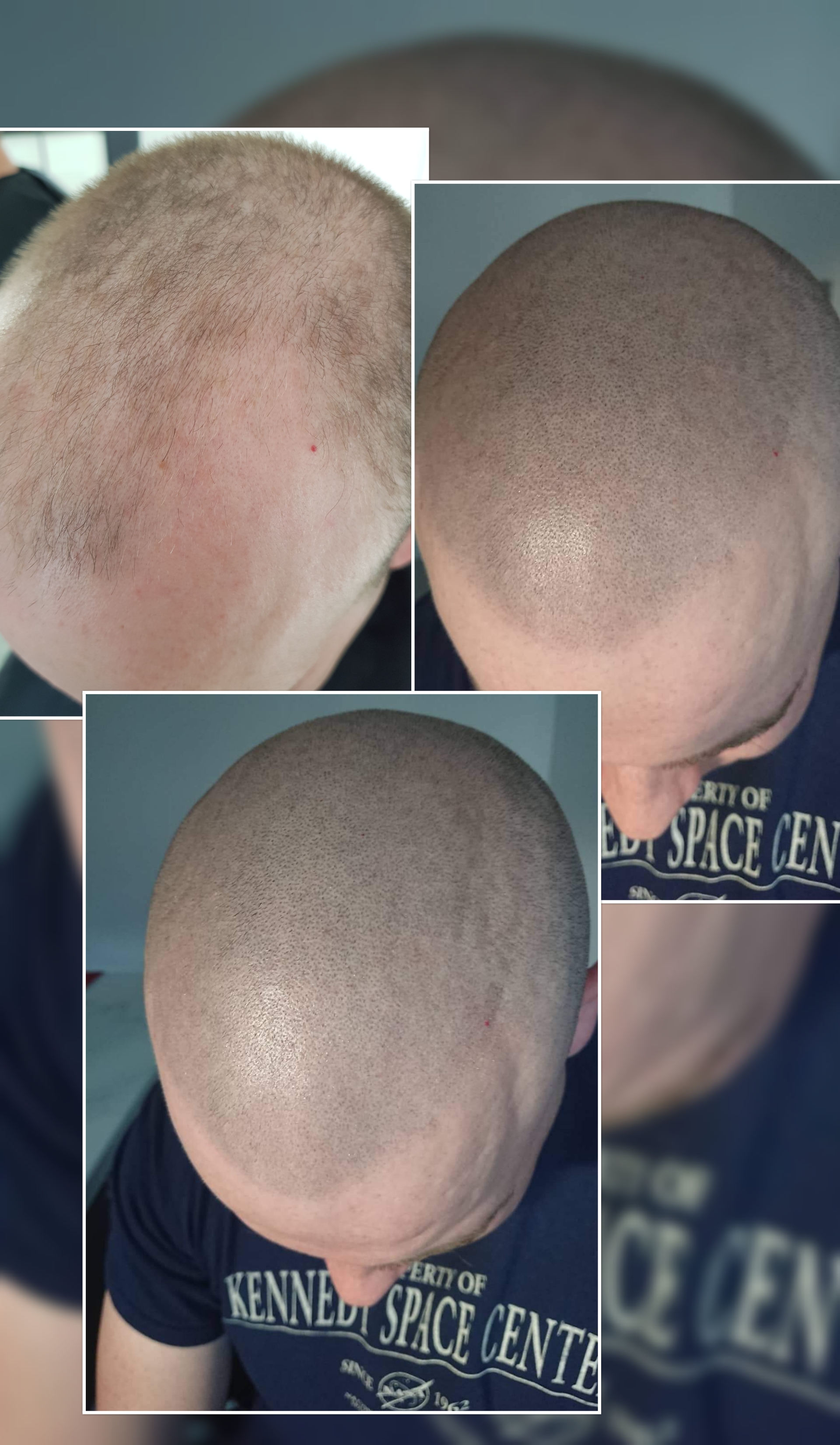 Scalp Micropigmentation