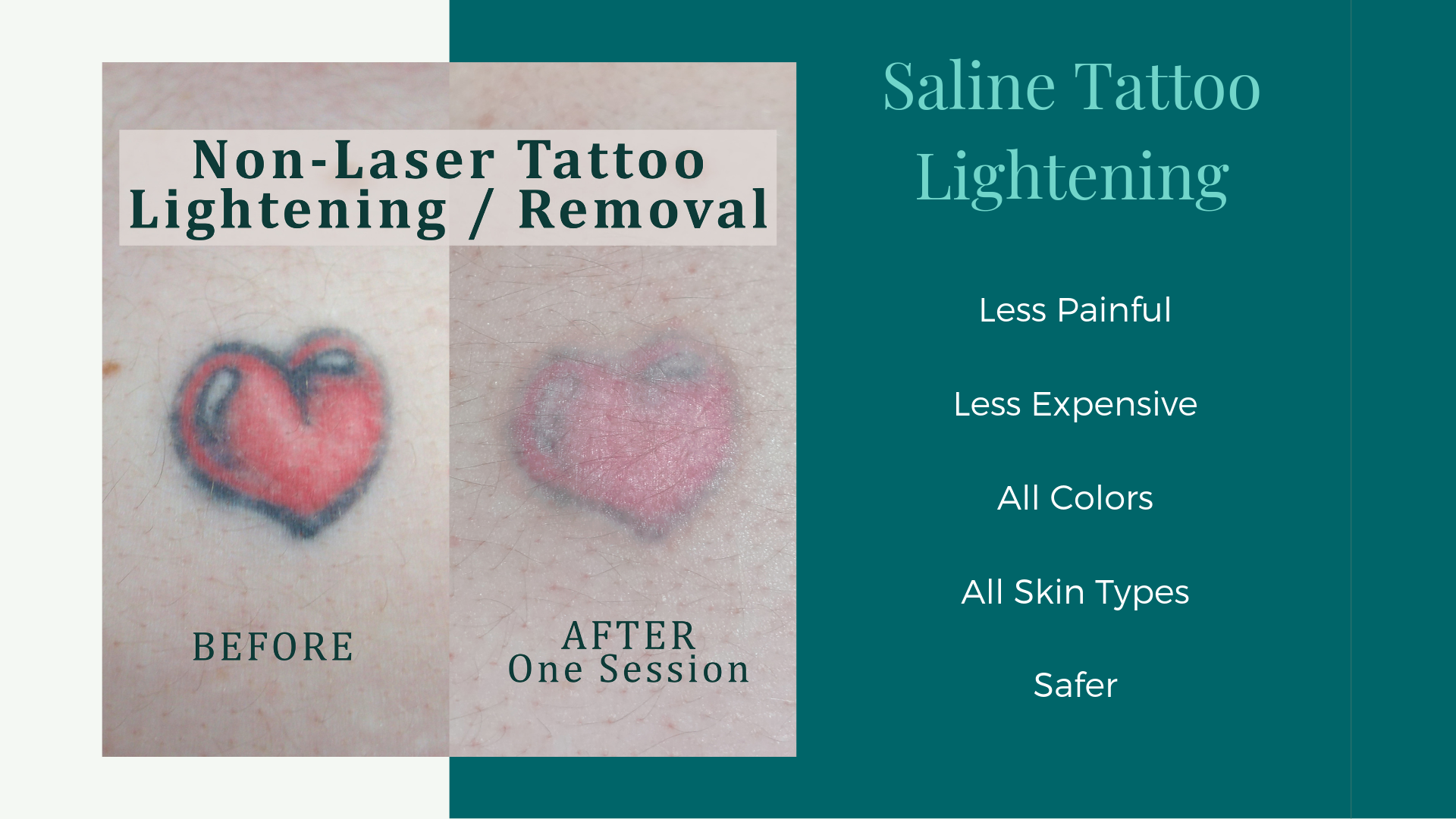 Delete Tattoo Removal  Medical Salon  Todays Before and After PicoWay laser  tattoo removal from Delete makes me want to sing I just want your extra  time  your kiss Did