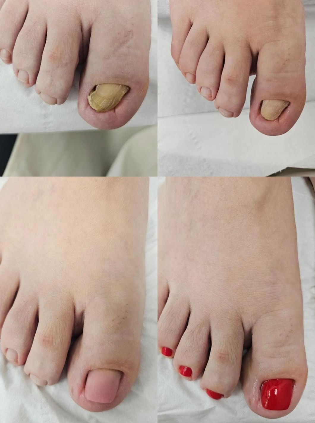 Toenail Reconstruction