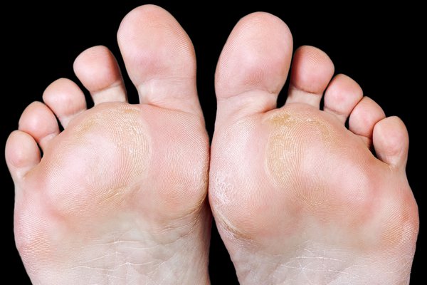 Callus of Feet Corn Removal Cracked Heels treatment