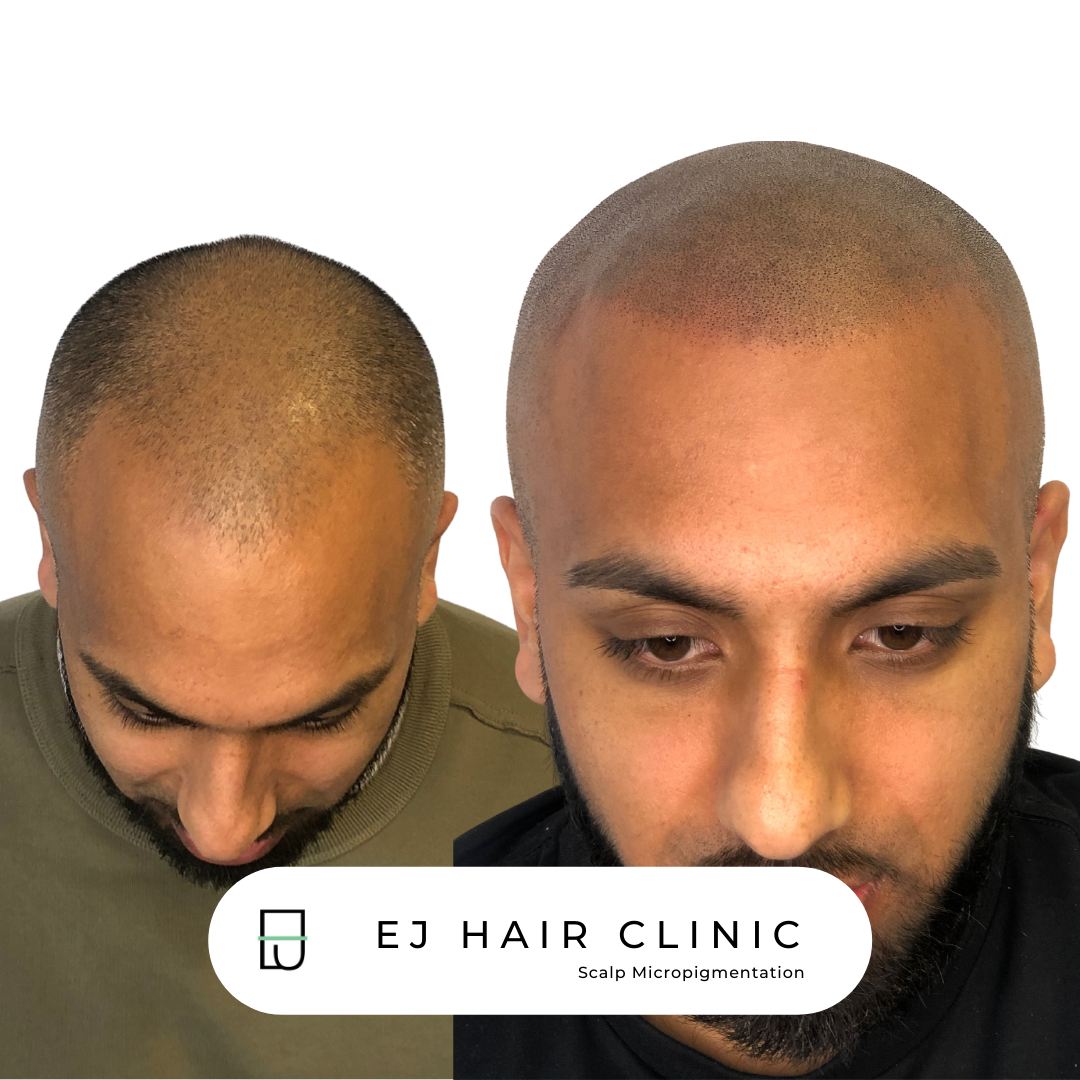 Hairline Restoration