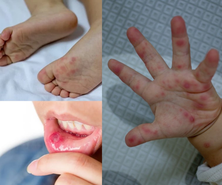 Hand, Foot, Mouth Disease