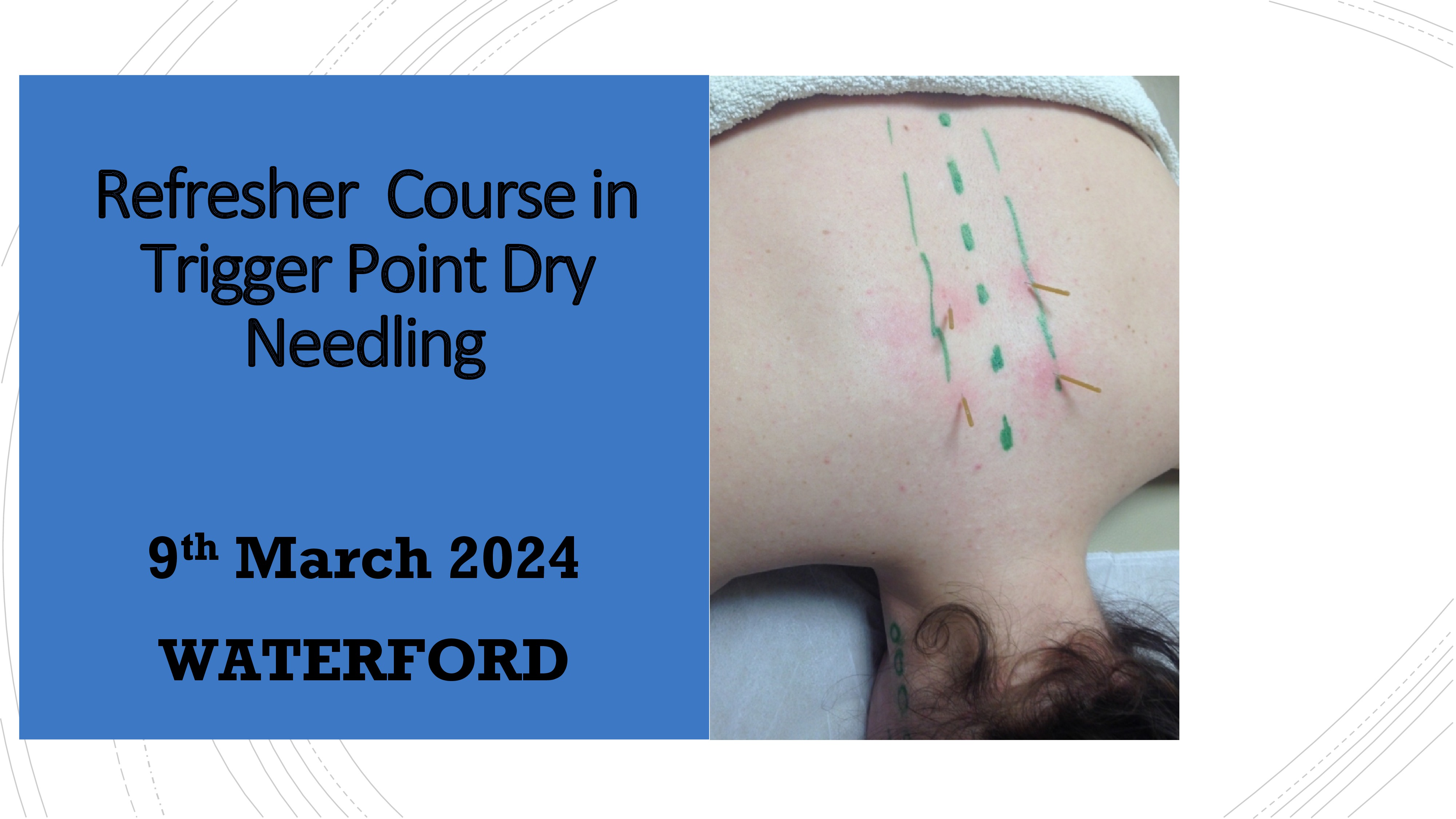 Refresher Course in Trigger Point Dry Needling, 9th March 2024, WATERFORD