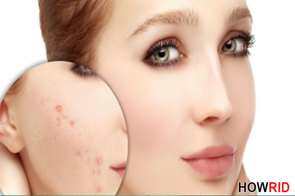 homemade-acne-scar-treatment-1.jpg