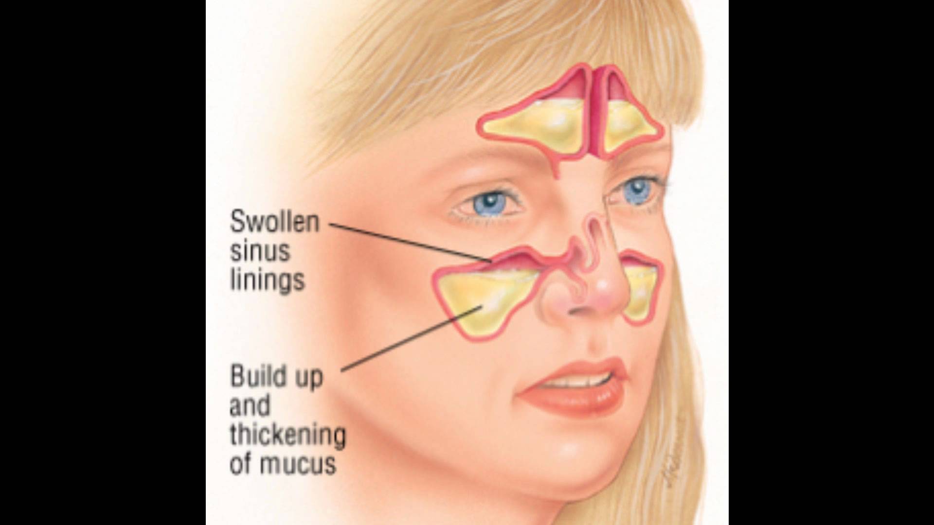 Синус симптомы. Припухлость в носовых пазухах.
