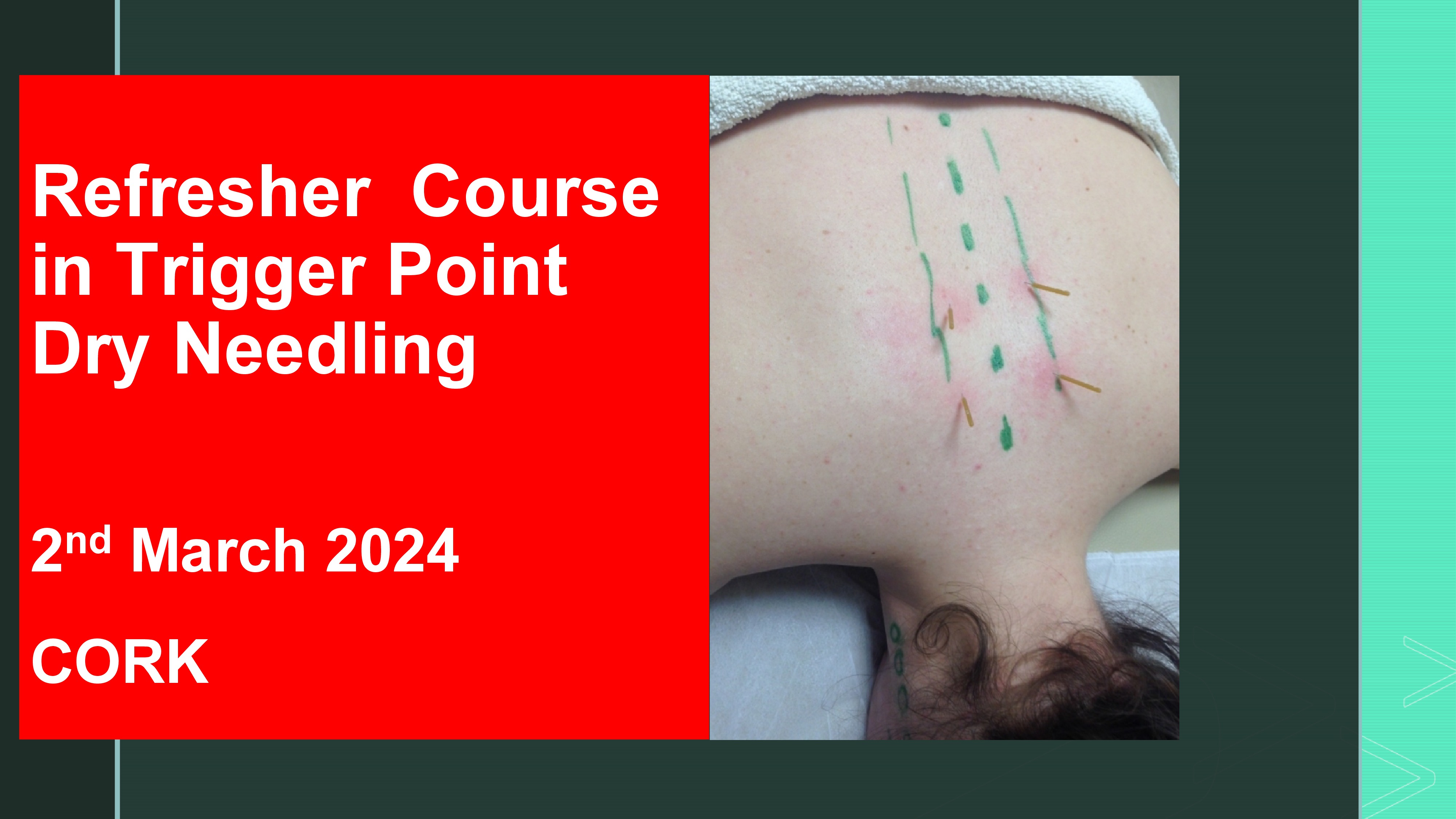 Refresher Course in Trigger Point Dry Needling 2nd March 2024, CORK