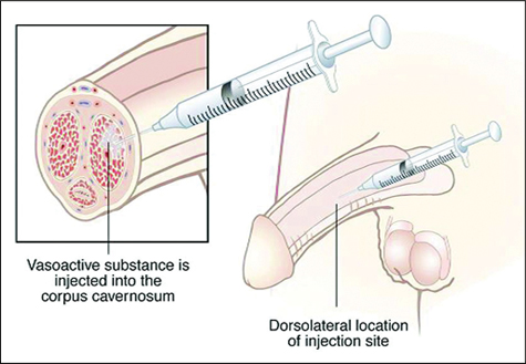 penile-injection-therapyjpg