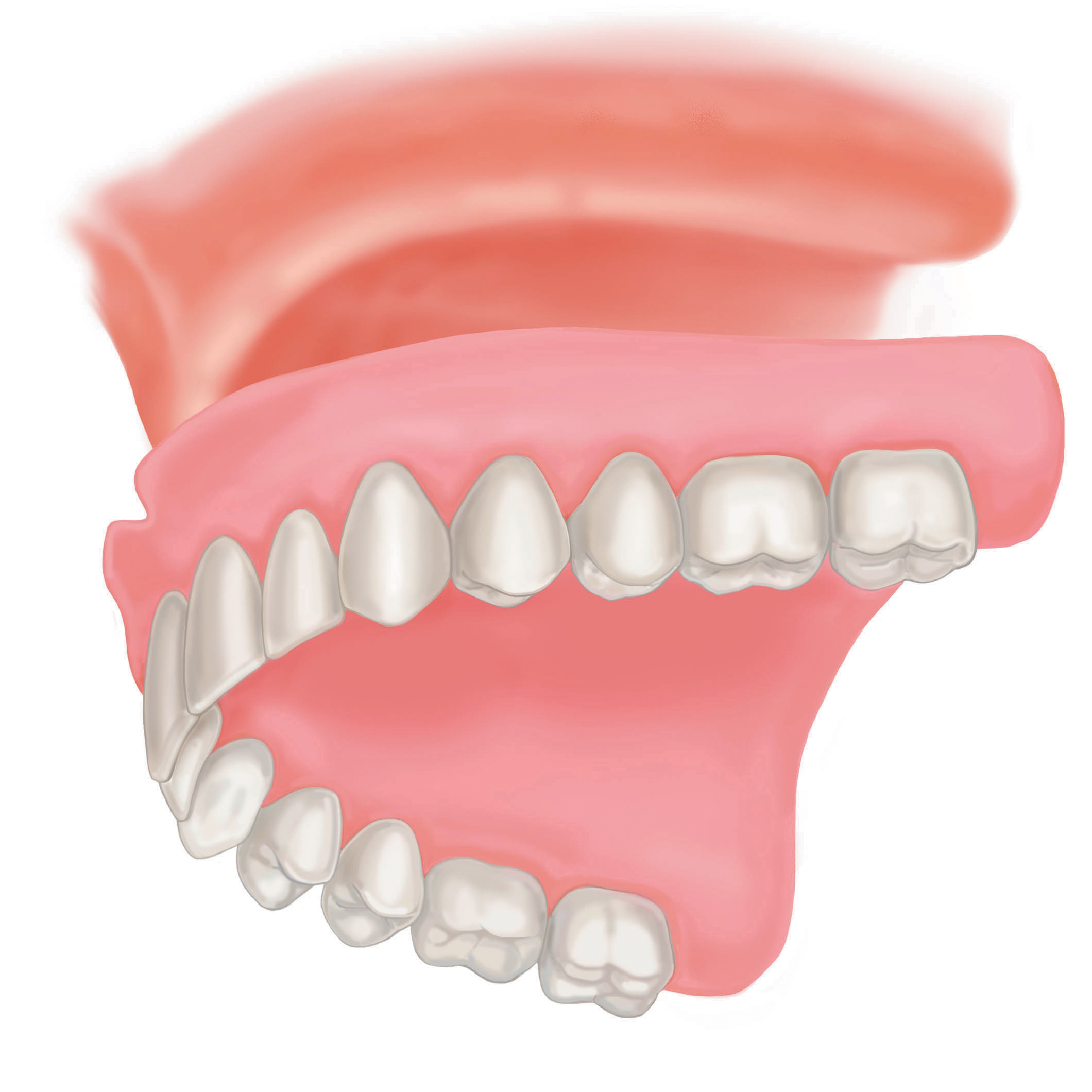 Протез на челюсть без зубов. Съёмный протез на верхнюю челюсть на имплантах. Условно-съемные балочные протезы. Протез на 2 имплантах на верхнюю челюсть. Протез на 4 имплантах верхней челюсти.